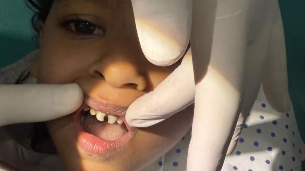 Broken or Cracked Tooth Treatment in Varanasi – Expert Dental Care at Oro Dental