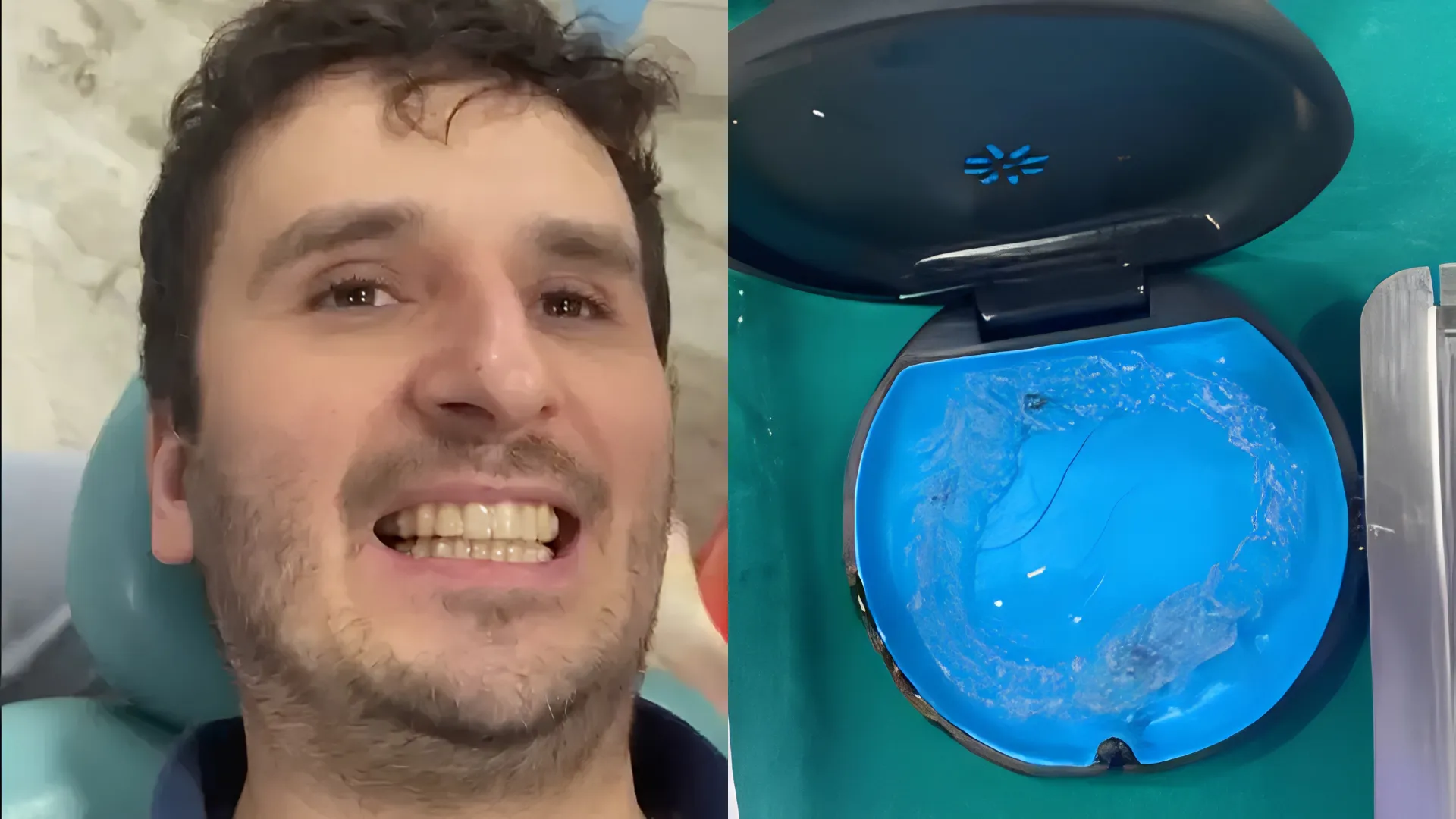Teeth Aligners at Oro Dental Clinic