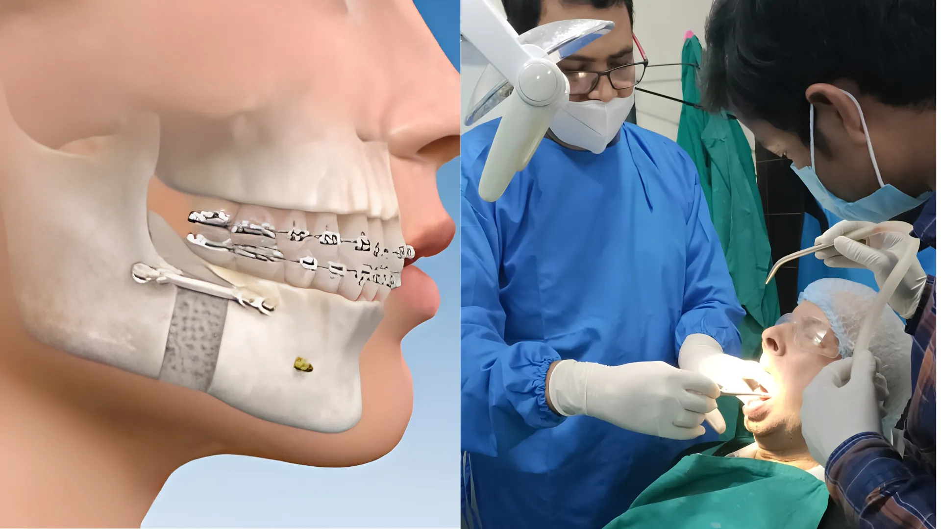 Jaw Fracture treatment at oro dental clinic