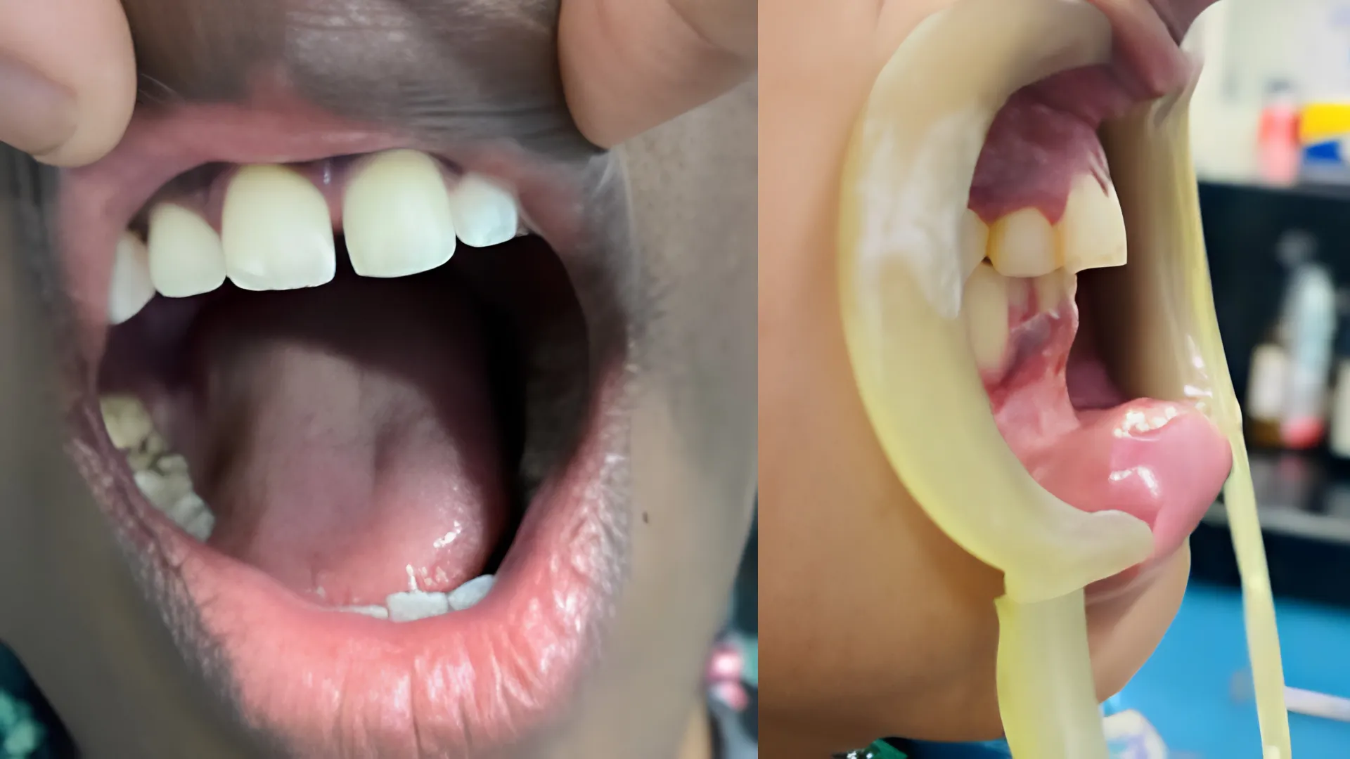 Gum Diseses Treatment at Oro Dental Clinic