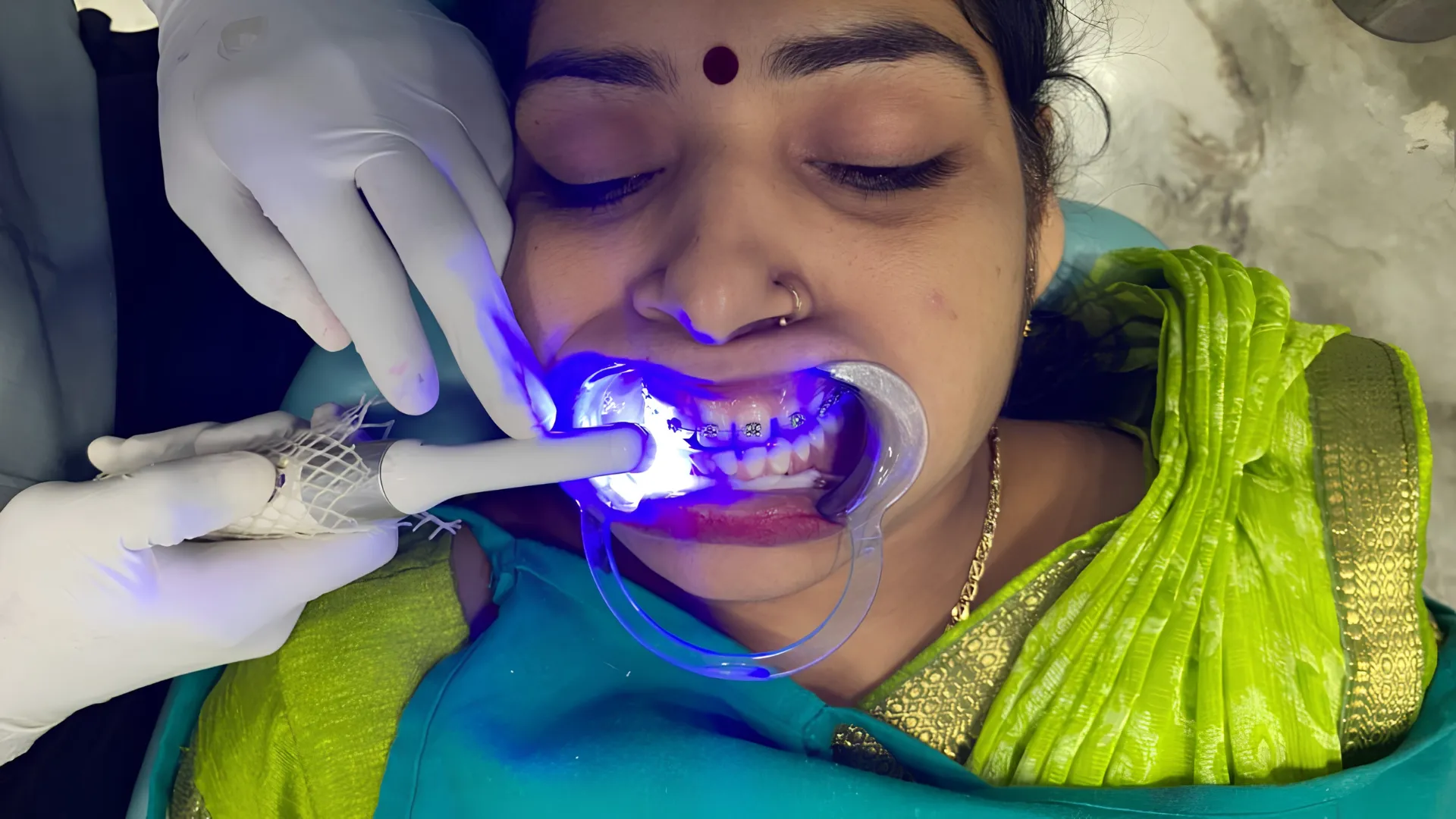 Fixed Braces ( Teeth Braces ) Treatment at oro dental clinic
