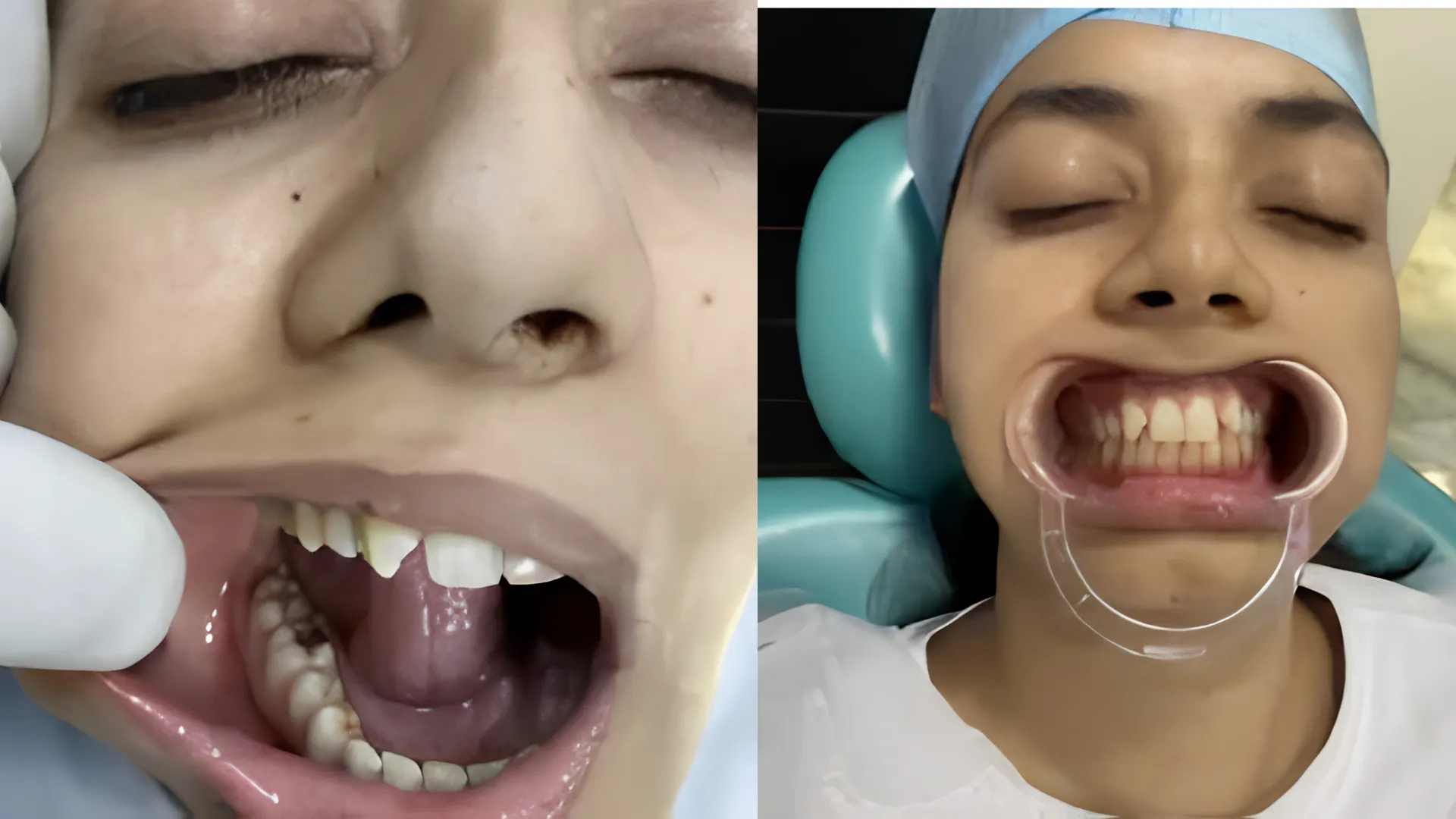 Crown (Tooth cap) & Bridge at oro dental clinic