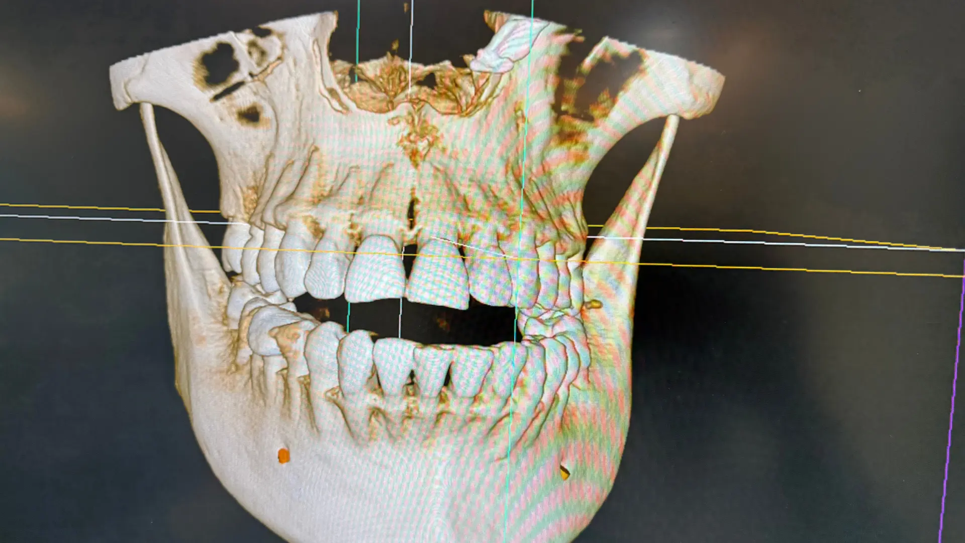 Oral & Maxillofacial Surgery at oro dental clinic