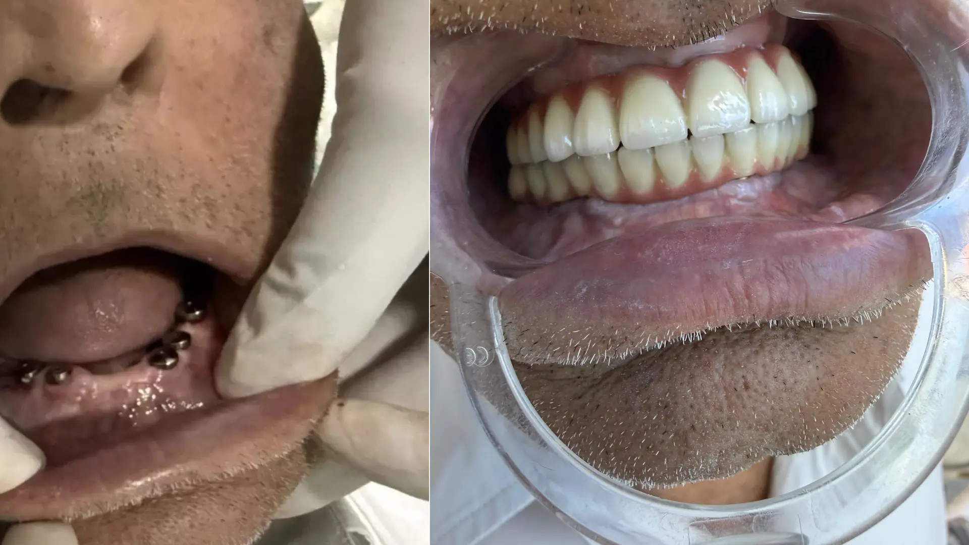 dental implant by oro dental best in varanasi