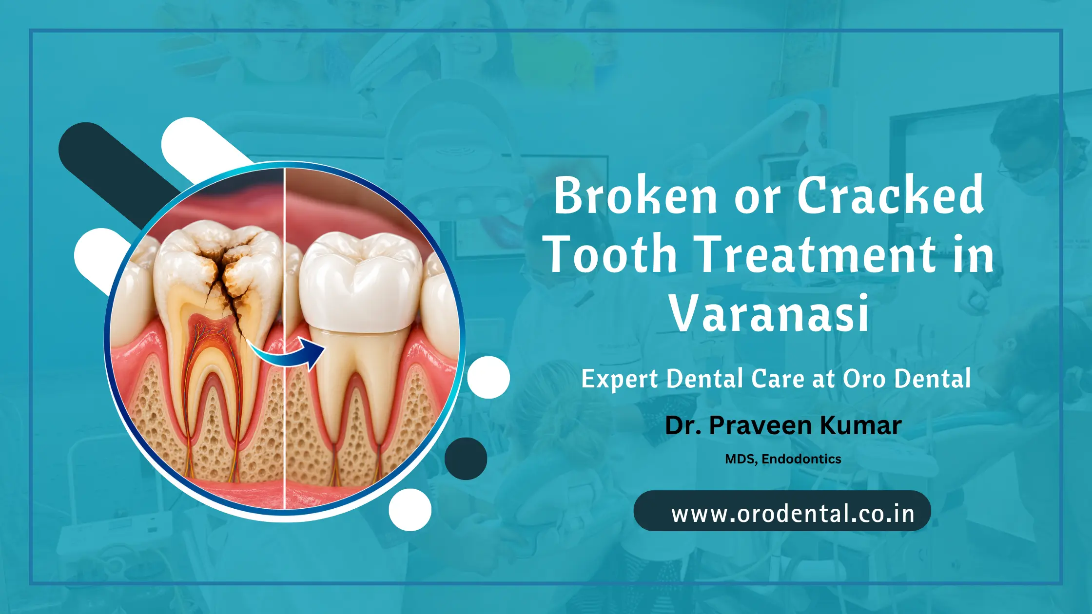 Broken or Cracked Tooth Treatment in Varanasi – Expert Dental Care at Oro Dental